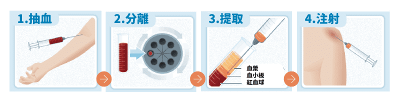 PRP進行方式