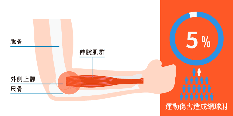 什麼是網球肘