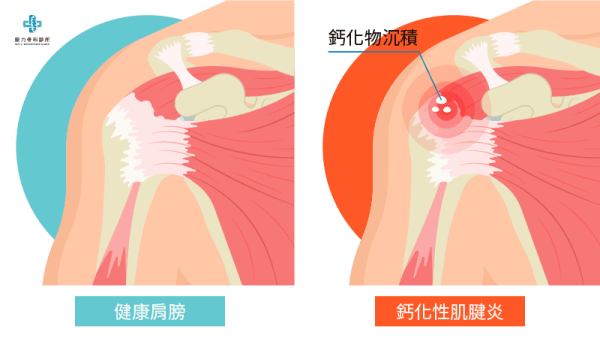什麼是鈣化性肌腱炎