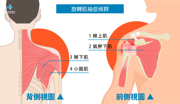 旋轉肌袖症候群